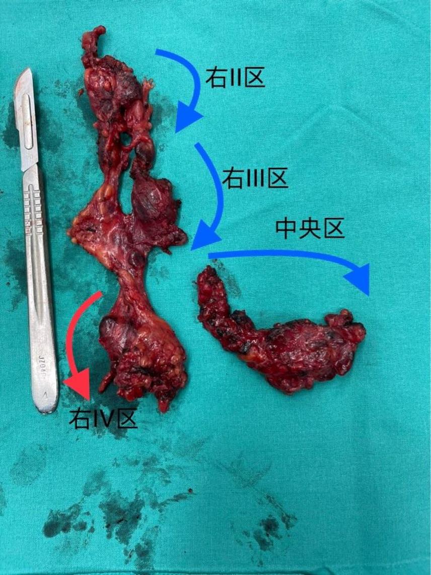 补硒能让肿块缩小吗(补硒可以补多长时间)-硒宝网