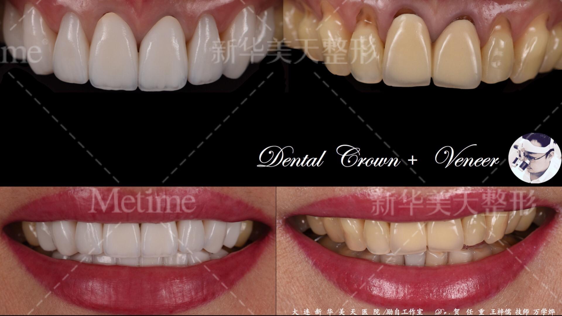 成人需要补钙吗(成人补钙需要吃多久)-硒宝网