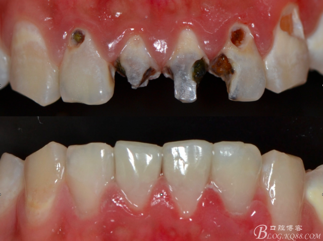 成人需要补钙吗(成人补钙需要吃多久)-硒宝网