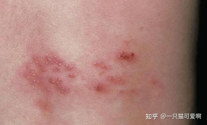 补硒能让淋巴肿大吗(淋巴结补硒)-硒宝网