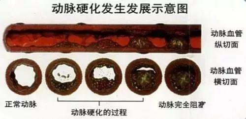 脑梗塞病人如何补硒(补硒对脑梗有哪些作用)-硒宝网