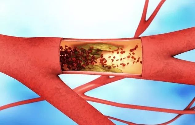 脑梗塞病人如何补硒(补硒对脑梗有哪些作用)-硒宝网