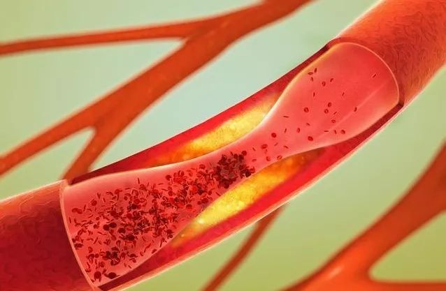 脑梗塞病人如何补硒(补硒对脑梗有哪些作用)-硒宝网