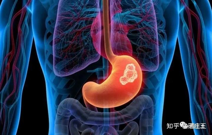 肺癌晚期补硒能好吗(肺癌晚期可以补硒吗)-硒宝网