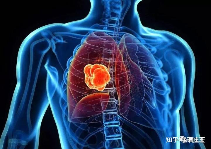 肺癌晚期补硒能好吗(肺癌晚期可以补硒吗)-硒宝网