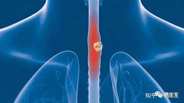 肺癌晚期补硒能好吗(肺癌晚期可以补硒吗)-硒宝网