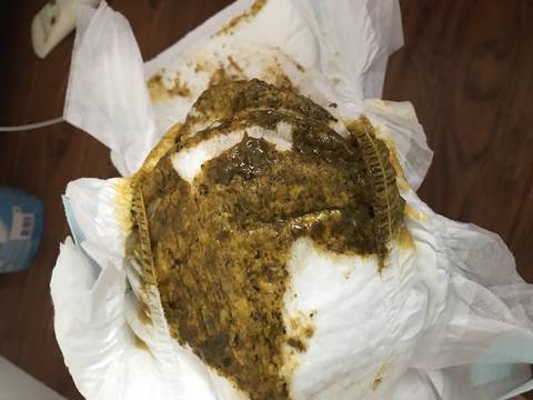 孕晚期补铁大便黑色（怀孕后期补铁大便黑色）-硒宝网