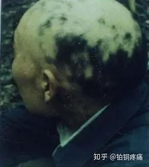 肝病补硒酵母的作用(硒酵母片治疗肝病吗)-硒宝网