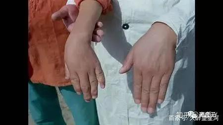 宝宝缺硒怎么补最快（宝宝缺硒会引起哪些疾?。?硒宝网