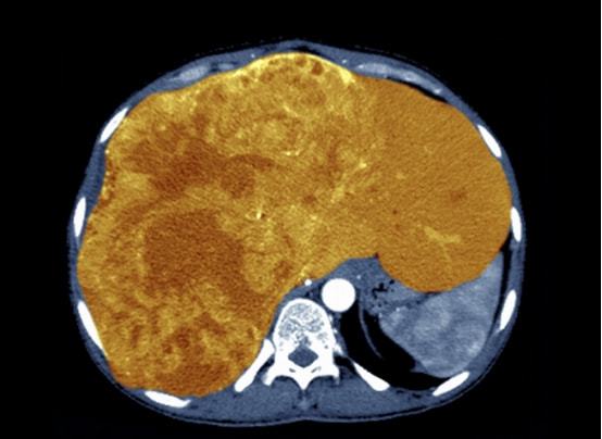 补硒可以治疗肝癌吗(肝癌补硒)-硒宝网