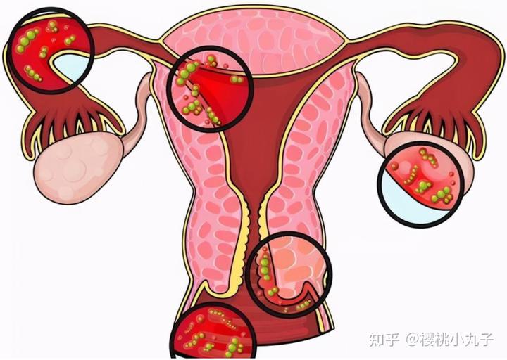 宫颈息肉补硒管用吗(宫颈息肉服用什么药)-硒宝网