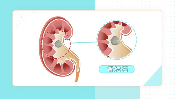肾结石患者怎么补钙（肾结石补钙患者能吃什么）-硒宝网