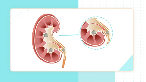 肾结石患者怎么补钙（肾结石补钙患者能吃什么）-硒宝网