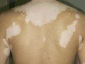 补硒能治疗白癜风吗（补硒能治好皮肤病吗）-硒宝网