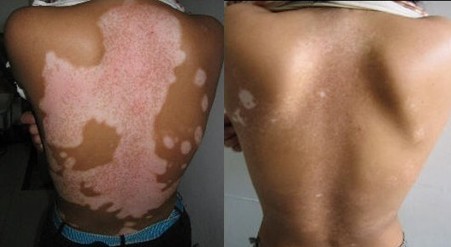 补硒能治疗白癜风吗(补硒治疗妇科病吗)-硒宝网