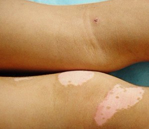 补硒能治疗白癜风吗(补硒治疗妇科病吗)-硒宝网