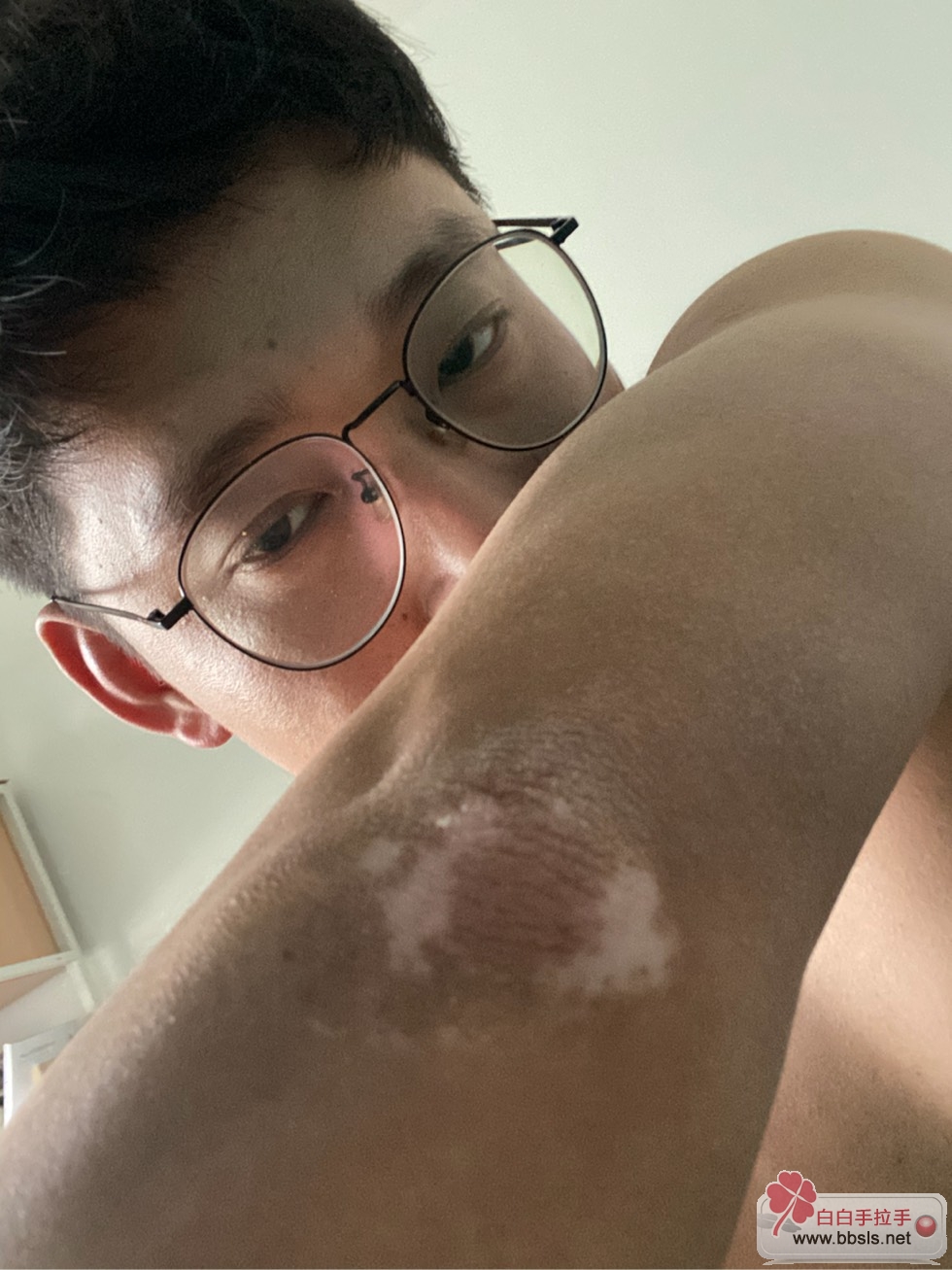 补硒能治疗白癜风吗(补硒治疗妇科病吗)-硒宝网