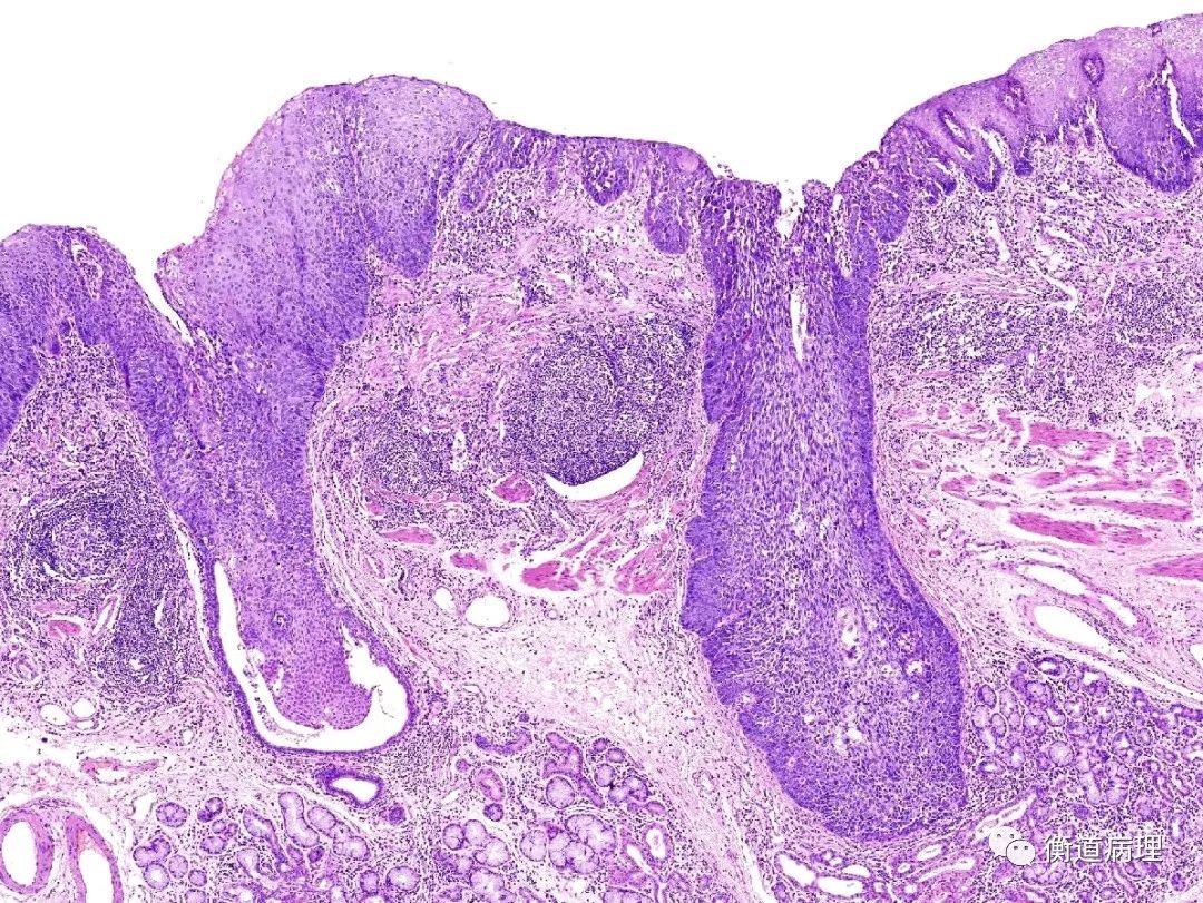 hpv补硒有效果吗(补硒可以治疗hpv阳性吗)-硒宝网