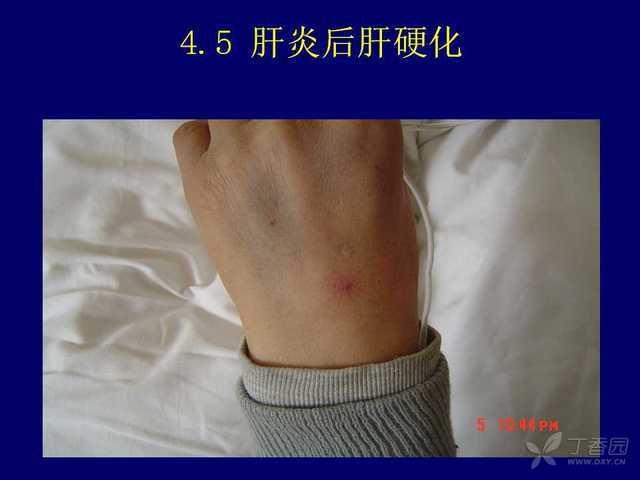 肝炎用什么补硒药物（药物补肝炎硒用量多少）-硒宝网