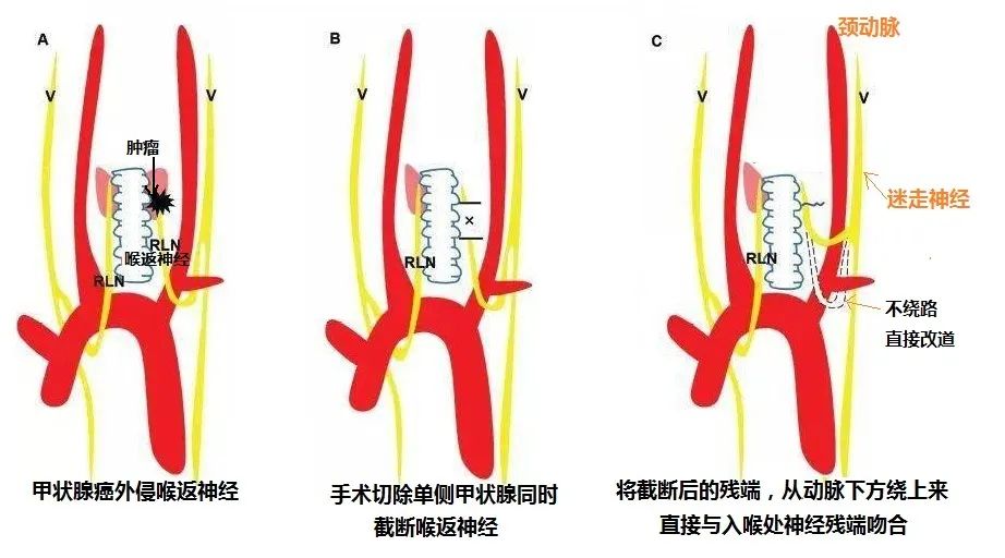 甲状腺癌术后 补硒（甲状腺癌术后用补硒吗）-硒宝网