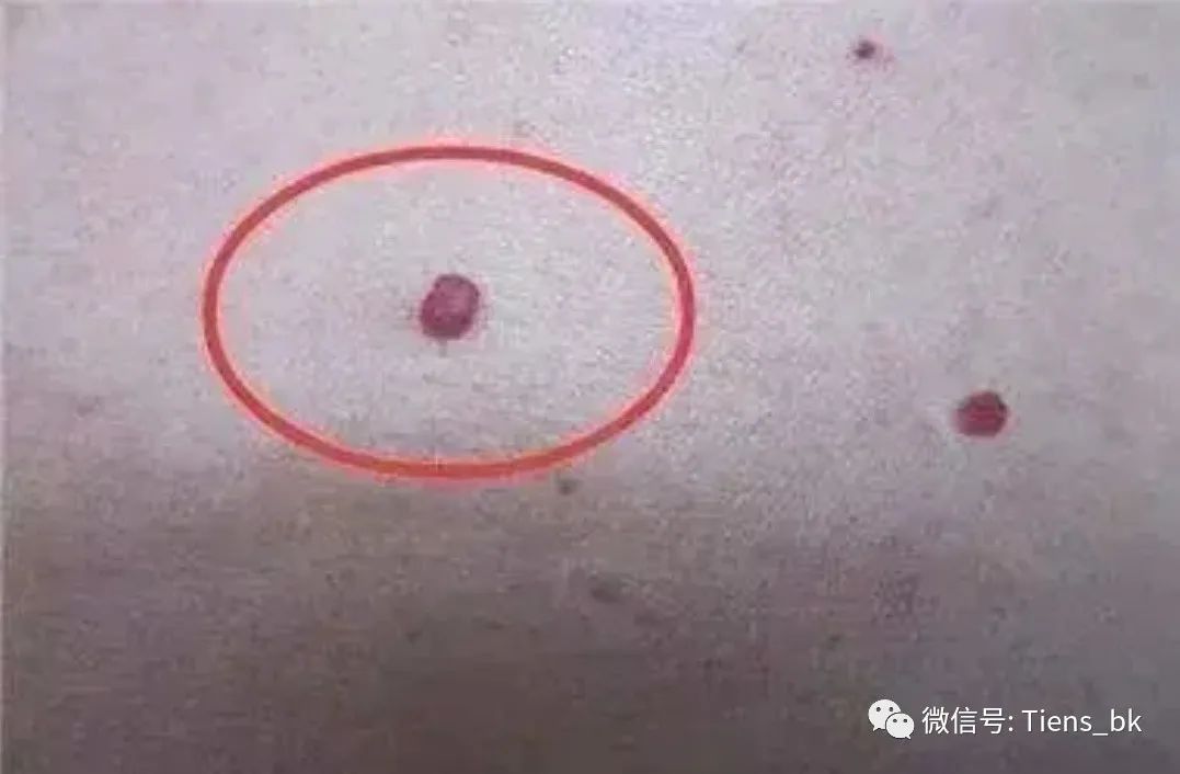 补硒迅速解除视疲劳(视疲劳的药物)-硒宝网