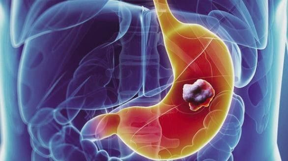 切除胃癌需要补硒吗(胃癌病人怎么补硒)-硒宝网