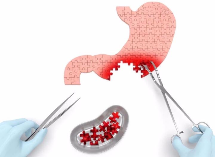 切除胃癌需要补硒吗(胃癌病人怎么补硒)-硒宝网