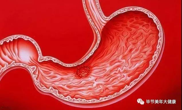 切除胃癌需要补硒吗(胃癌术后需要补硒吗)-硒宝网