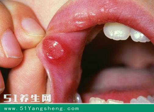 口腔白斑可以补硒吗(硒白斑能吃吗)-硒宝网