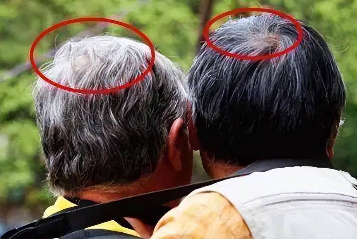 补硒可以治疗白发吗(硒白发)-硒宝网