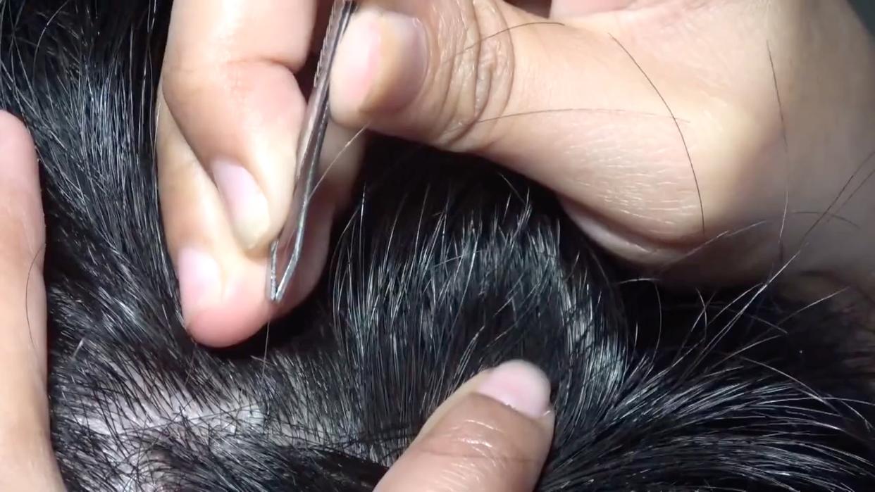 补硒可以治疗白发吗(硒白发)-硒宝网