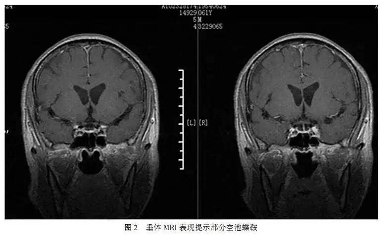盐胶囊补钠口服用量(胶囊装盐补钠)-硒宝网