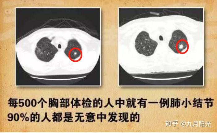 补硒可以治好肺结节(肺结节吃硒有用吗)-硒宝网