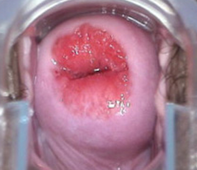 补硒能治好hpv吗(补硒治疗hpv)-硒宝网