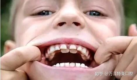 5岁小孩可以补硒吗（儿童可以补硒）-硒宝网