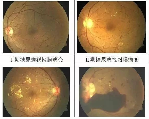 糖尿病需要补硒多久(糖尿病补硒有什么好处)-硒宝网