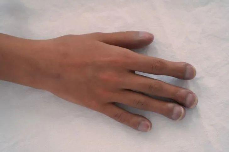 肺纤维补硒有效果吗（肺纤维能治疗吗）-硒宝网