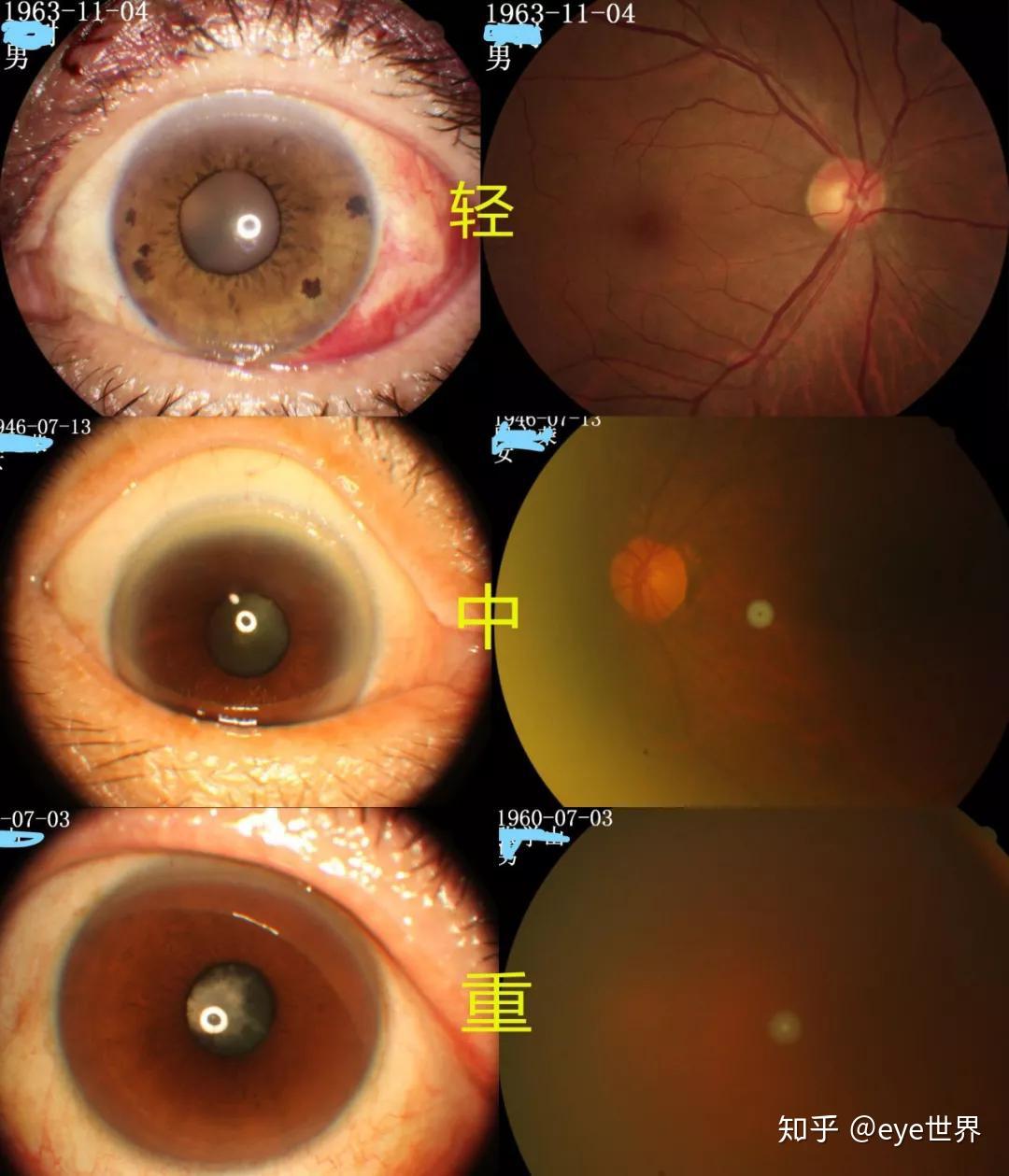 补硒能预防白内障吗(白内障吃硒能有什么效果)-硒宝网