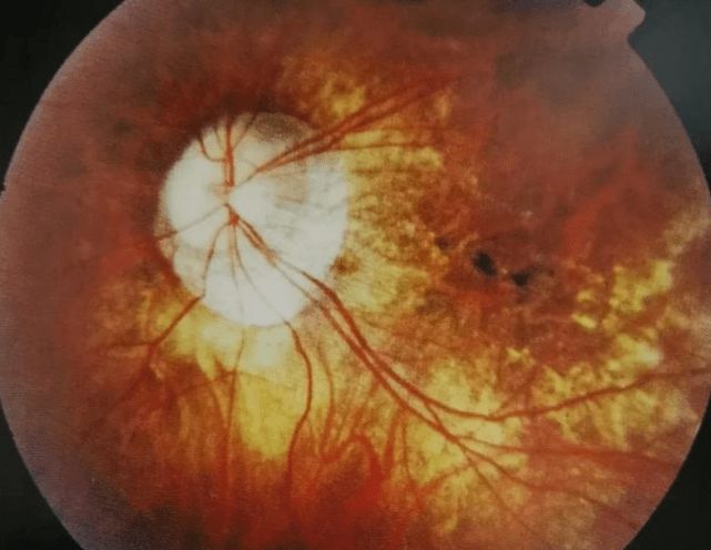 补硒能预防白内障吗(白内障吃硒能有什么效果)-硒宝网