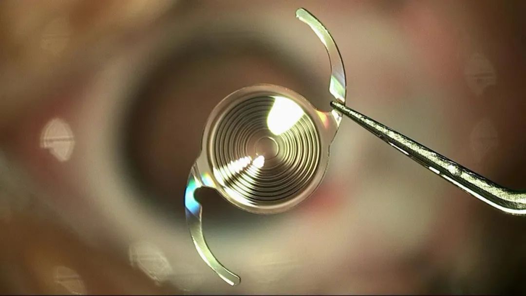 补硒能预防白内障吗(白内障吃硒能有什么效果)-硒宝网