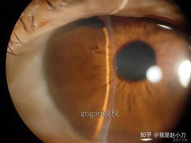 补硒能预防白内障吗(白内障吃硒能有什么效果)-硒宝网