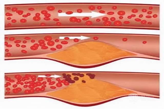 心肌缺血补硒有用嘛(补心肌缺血硒用有什么作用)-硒宝网
