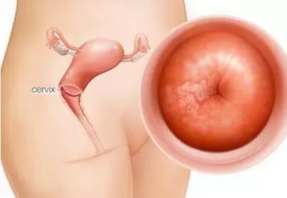 补硒可以预防宫颈癌(补硒治疗hpv)-硒宝网