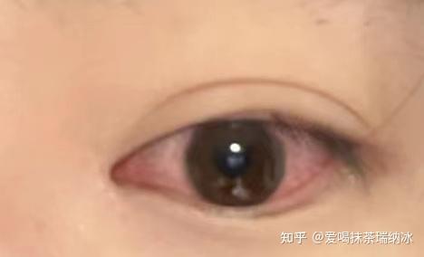 眼睛模糊补硒可以吗(补硒对眼睛好吗)-硒宝网