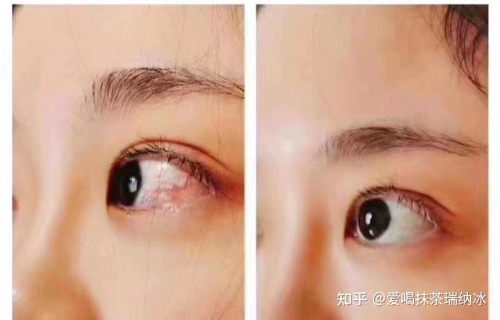 眼睛模糊补硒可以吗(补硒对眼睛好吗)-硒宝网