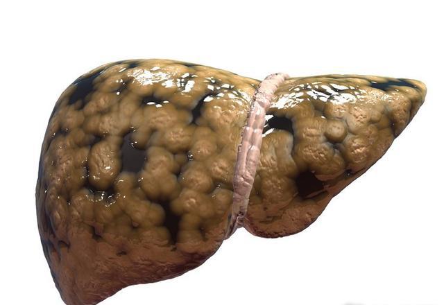 脂肪肝每天补硒多少(每天肝脂肪补硒多少克)-硒宝网