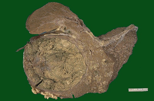 脂肪肝每天补硒多少(每天肝脂肪补硒多少克)-硒宝网