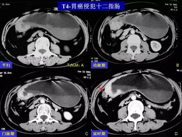 有胃炎萎缩能补硒吗(萎缩性胃炎要吃多少硒)-硒宝网