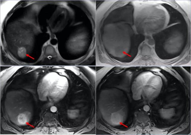 酒精肝病人怎么补硒（硒对酒精有分解作用吗）-硒宝网