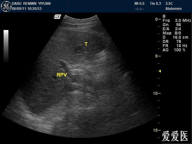 酒精肝病人怎么补硒（硒对酒精有分解作用吗）-硒宝网